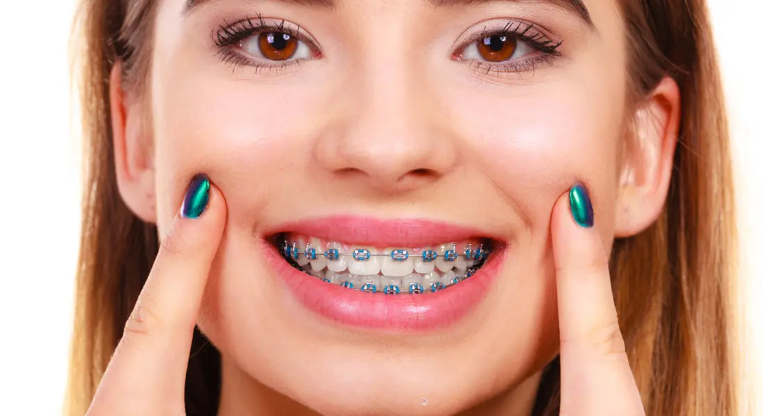 When Should My Child Get Braces in Milwaukee?