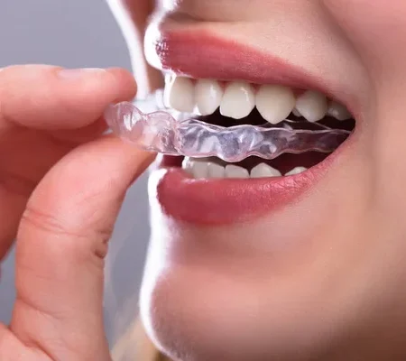 The Rise of Clear Aligners for Kids: Why 2025 is the Year to Start Early Orthodontic Treatment