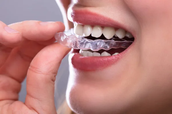 Orthodontic Clear Aligners