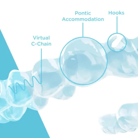 Overcoming Challenges with Spark Aligners: Tips for a Successful Treatment