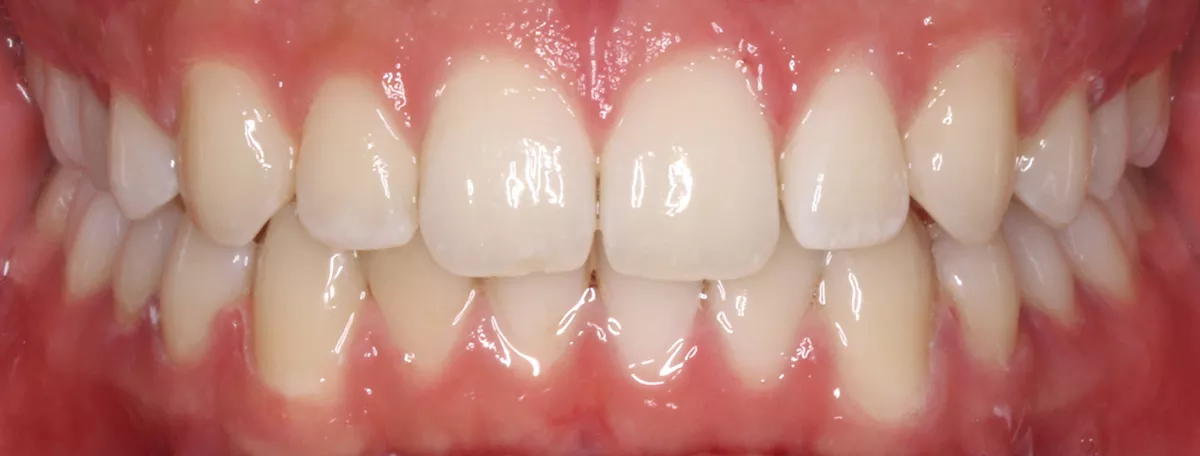 After treatment result for Patient Q